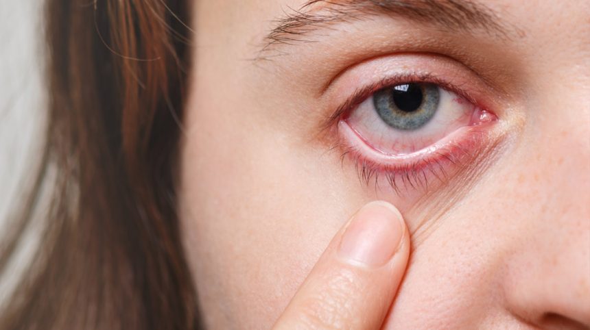 Are Your Eyes Ready for Allergy Season?