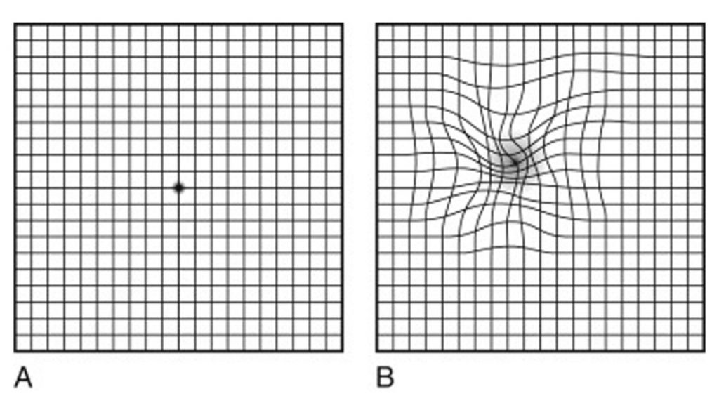 Amsler Grid - Srs Eye Hospital