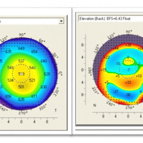 CCT-corneal thickness map